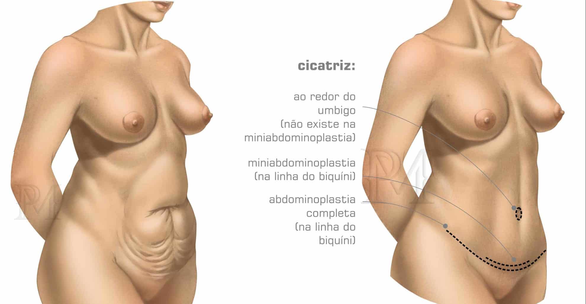 Abdominoplastia em Porto Alegre - Antes e Depois - Dr. Daniel Pinheiro Machado | Cirurgião Plástico