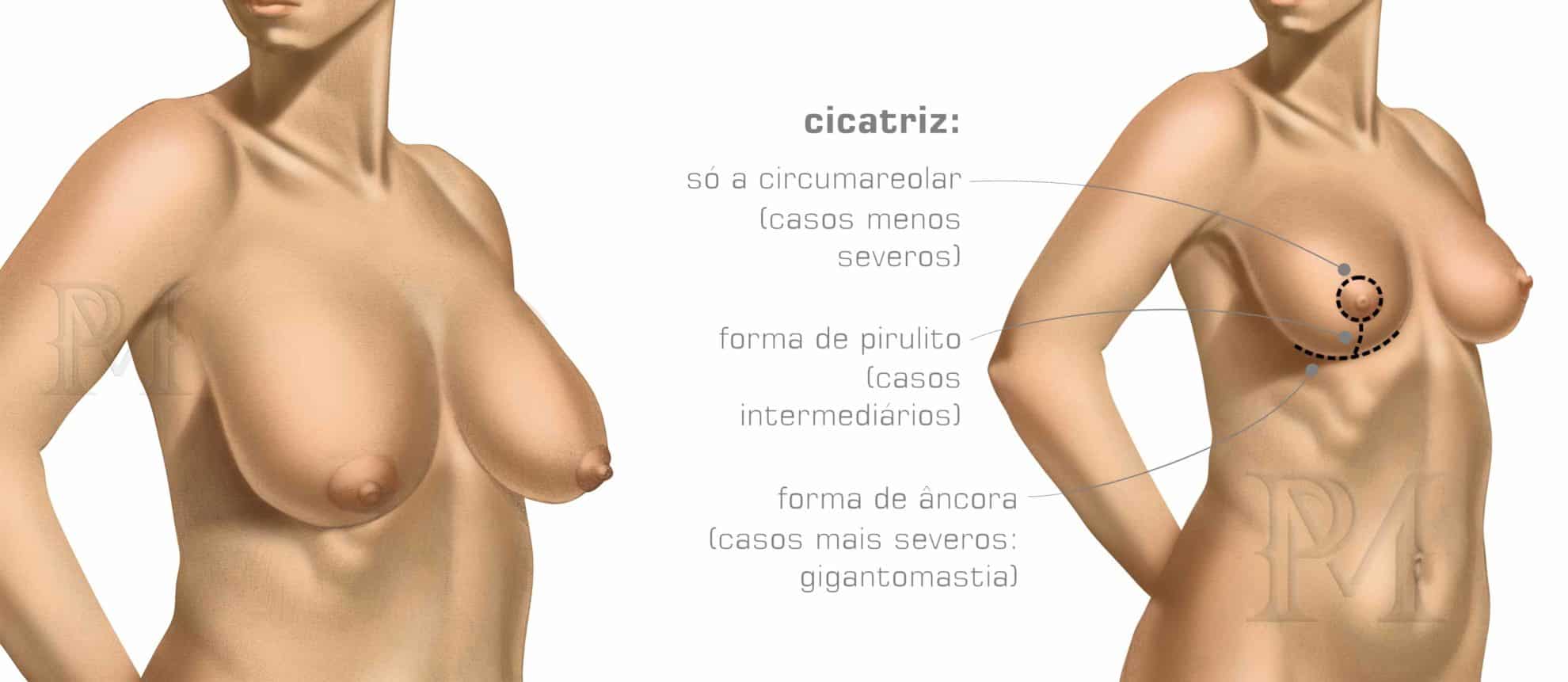 mamoplastia redutora antes e depois - Dr. Daniel Pinheiro Machado | Cirurgião Plástico